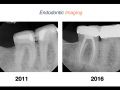 Endodontic Case 10 - #30:31 - Part 2 - Diagnosis