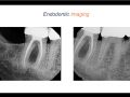 Endodontic Case 10 - #30:31 - Part 3 - Diagnosis