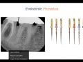 Endodontic Case 10 - #30:31 - Part 4 - Endodontic Treatment