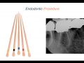 Endodontic Case 10 - #30:31 - Part 5 - Obturation