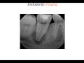 Endodontic Case 11 - Part 1 - Diagnosis