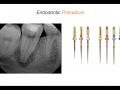 Endodontic Case 11 - Part 3 - Endodontic Procedure