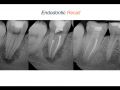 Endodontic Case 11 - Part 4 - Recall