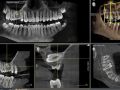 Using the CBCT to Plan Impacted Tooth Surgery