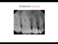 Endodontic Case 12 - ProTaper Ultimate - Premolar Diagnosis