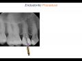 Endodontic Case 12 - ProTaper Ultimate - Premolar Procedure