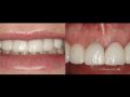 Esthetic Zone Immediate Implant Placement Complication