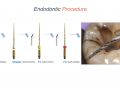 Endodontic Case 13 - Anterior Trauma - Procedure - Part 2