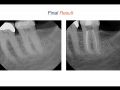 Endodontic Case 14 - New Crown Endodontics - Final Treatment