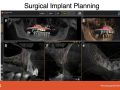 Implant Case Delay Due to Failure of Original Placement - Part 3 - Second Surgical Phase