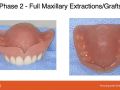 Edentulous Full Arch Implant Planning - Part 2 - Planning and Preparation