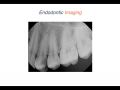 Endodontic Case 16 - Straightforward Endodontic Treatment Premolar - Diagnosis