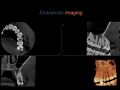 Endodontic Case 16 - Straightforward Endodontic Treatment Premolar - CBCT Findings