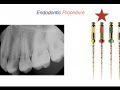 Endodontic Case 16 - Straightforward Endodontic Treatment Premolar - Procedure