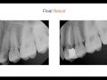 Endodontic Case 16 - Straightforward Endodontic Treatment Premolar - Obturation