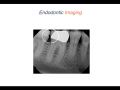 Endodontic Case 17 - Crown vs. Broken Restoration - Imaging