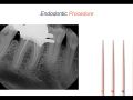 Endodontic Case 17 - Crown vs. Broken Restoration - Obturation