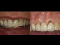 Implant Therapy Sites #7-8 - Part 1