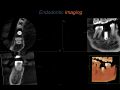 Endodontic Case 18 - Endo/Implant - Imaging