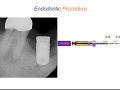 Endodontic Case 18 - Endo/Implant - Procedure