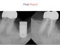 Endodontic Case 18 - Endo/Implant - Obturation