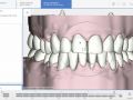 11 - 3D Movement of Teeth