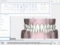 12 - Adjusting Teeth By Numbers