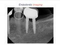 Endodontic Case 19 - Difficult Mandibular Premolar - Imaging