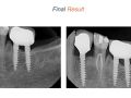 Endodontic Case 19 - Difficult Mandibular Premolar - Obturation