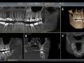 Typical CBCT Finding...Would You Have Missed This?
