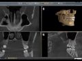 Incidental Finding in CBCT