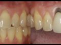 Difficult Esthetic Implant with Complications