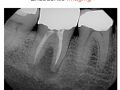 Endodontic Case 20 - #31 Retreatment - Diagnosis