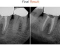 Endodontic Case 20 - #31 Retreatment - Obturation