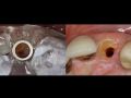 Partial Extraction Therapy with Primetaper Implant