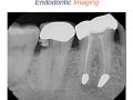 Endodontic Case 21 - #31 RCT - Imaging