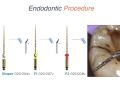 Endodontic Case 21 - #31 RCT - Procedure