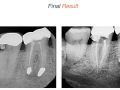 Endodontic Case 21 - #31 RCT - Obturation