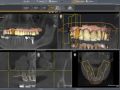 Need for Drill Extension on Periodontal Case