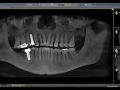 Endodontist Said 19 Was Fractured