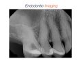 Endodontic Case 22 - Previous Accessed Molar - Diagnosis