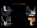 Endodontic Case 22 - Previous Accessed Molar - Imaging