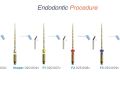 Endodontic Case 22 - Previous Accessed Molar - Procedure