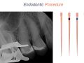 Endodontic Case 22 - Previous Accessed Molar - Obturation