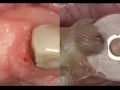 Implant Therapy #7-8 Part 2