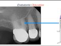 Endodontic Case 23 - 4 Canal Molar - Obturation