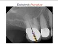 Endodontic Case 23 - 4 Canal Molar - Procedure