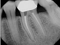 Case 25: Calcified Molar - Obturation
