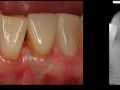 Anterior Mandibular Implant Therapy Part 1