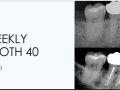 1. Weekly Tooth 40 - Silver Points/ Missed Canal/ Sealer